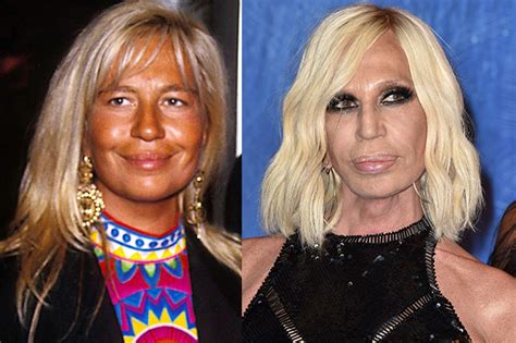 Donatella Versace, prima e dopo: la chirurgia l’ha 